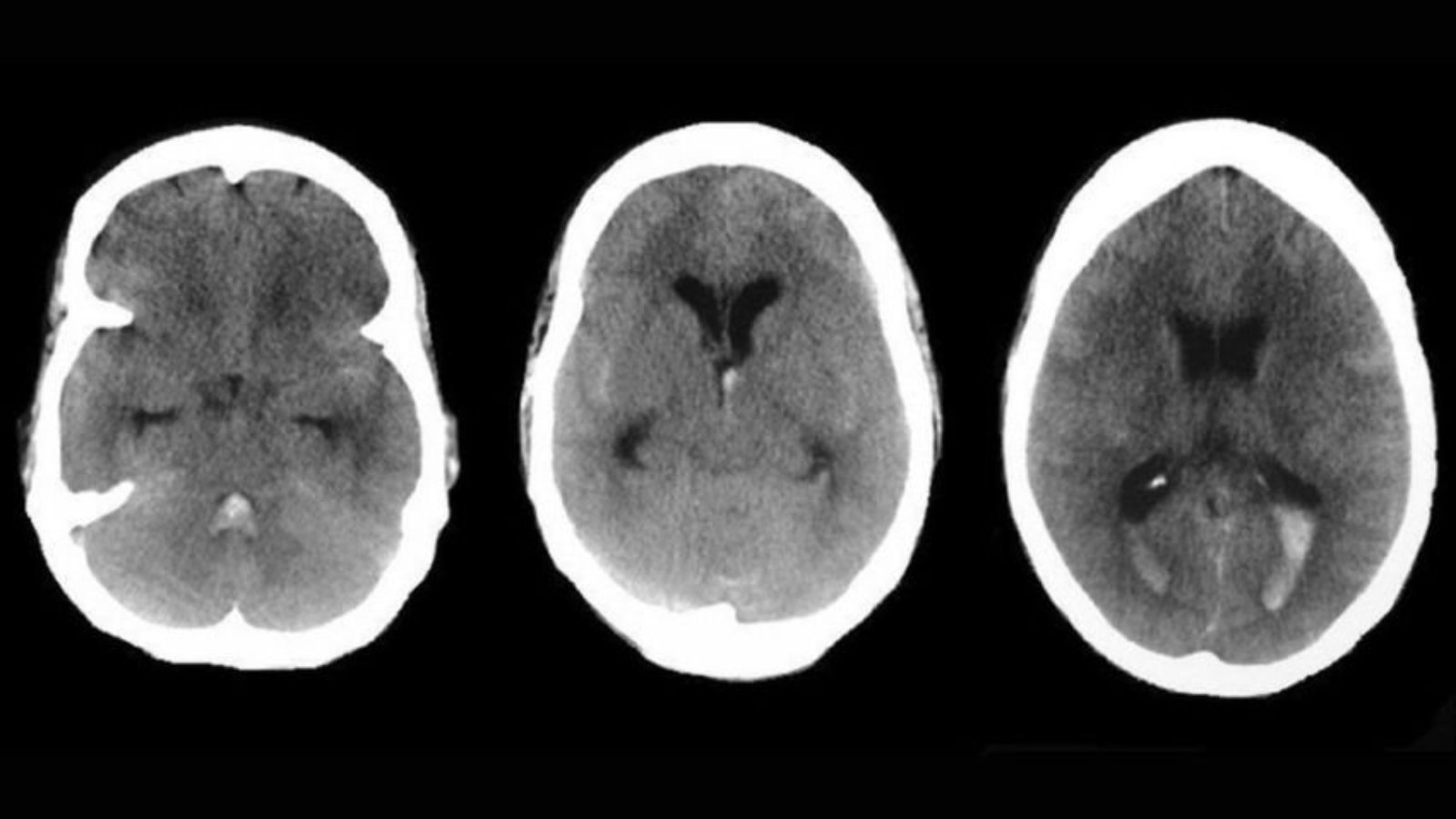 brain_aneurysm_cover
